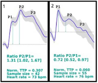 Case Report: Untreatable Headache in a Child With Ventriculoperitoneal Shunt Managed by Use of New Non-invasive Intracranial Pressure Waveform